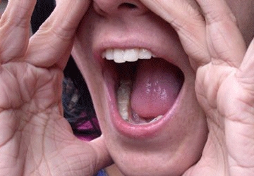 Dott.ssa Monica Patrucco, logopedista, spiega il disturbo della Disfonia